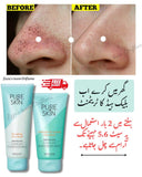 Pure Skin 5-Step Facial Set For OILY Skin types Dermatologically tested
