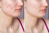 Glow Essential Soap & SOS blemish gel for all skin types